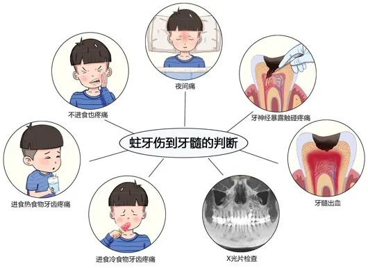 可复性牙髓炎的症状是怎样的,蛀牙引起的牙髓炎有什么症状