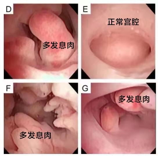 不同部位的多发息肉如何取病理,身上多处长息肉是怎么回事