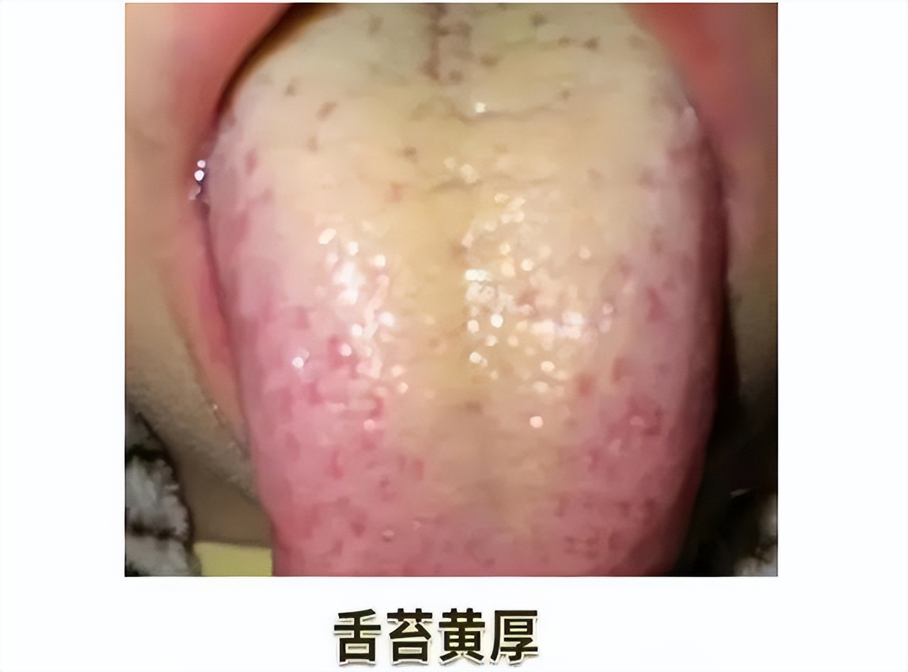 频繁喝酒引发排尿困难、尿痛？中医经验：对症调理湿热型前列腺炎