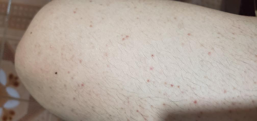 如何避免阴虱传播,阴虱的传播途径有哪些