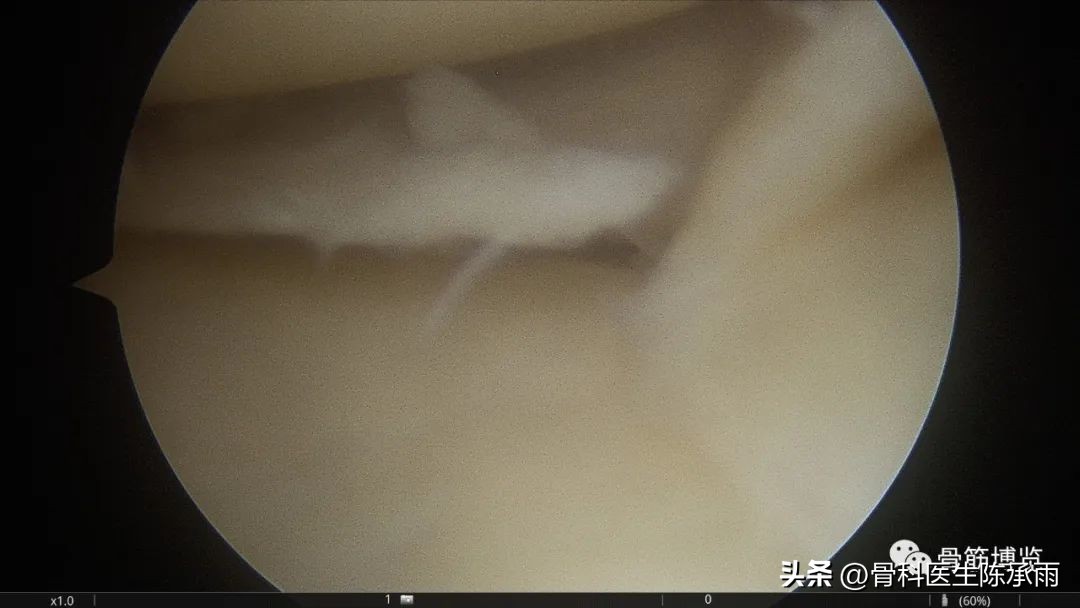 盘状半月板撕裂一级,半月板层裂愈合概率