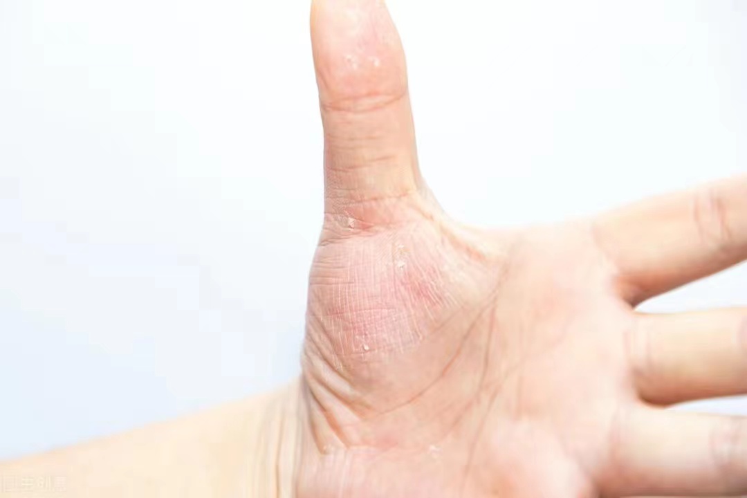 湿疹荨麻疹特别痒用什么药能治好,荨麻疹汗疱疹湿疹中药治疗