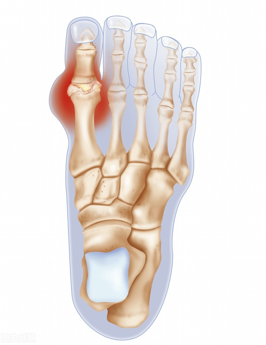 痛风脚底板疼有啥忌口,脚底疼是痛风的前兆