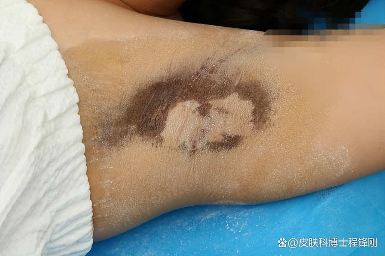 狐臭手术10年了现在为什么会复发,狐臭手术一年后还是有味道怎么办