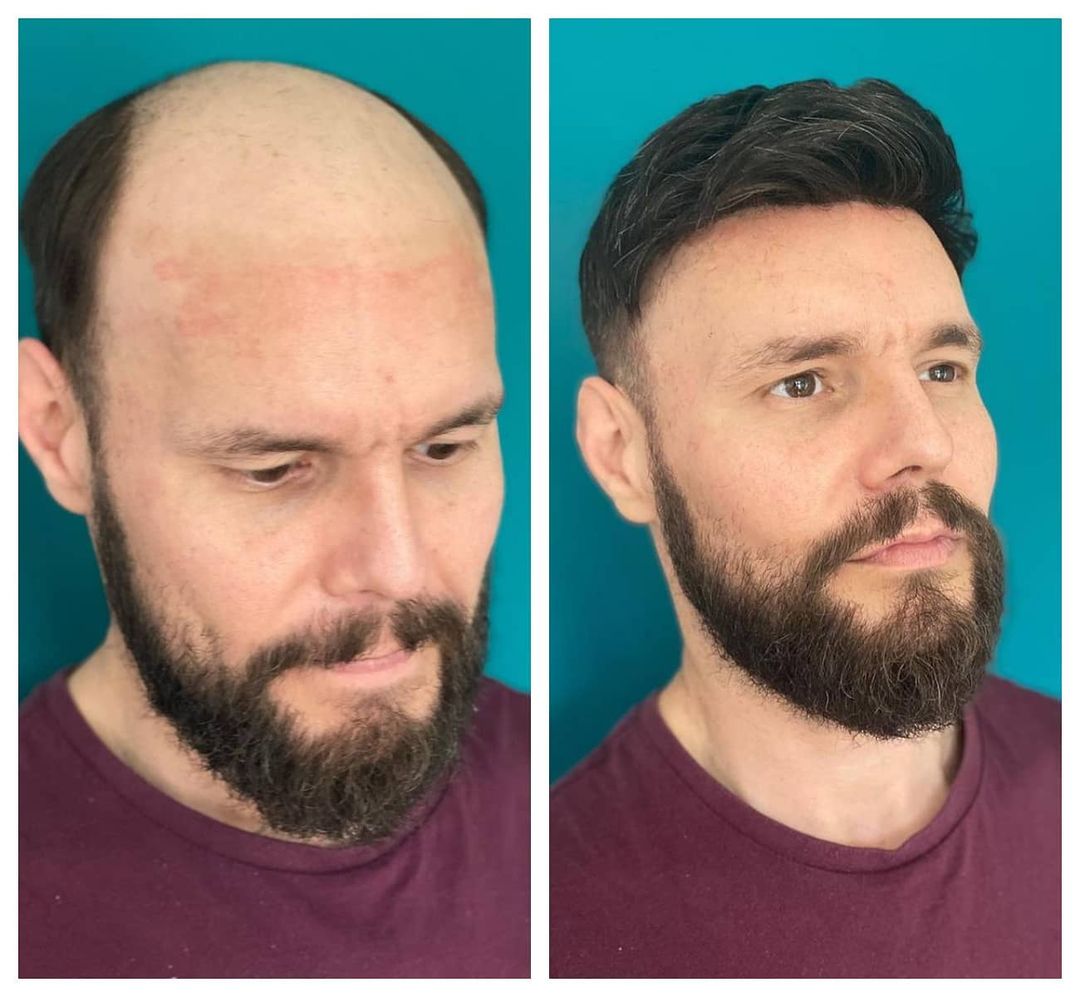 想戴假发又不想剃头发？夹式发片直接搞定！简直就是增发神器