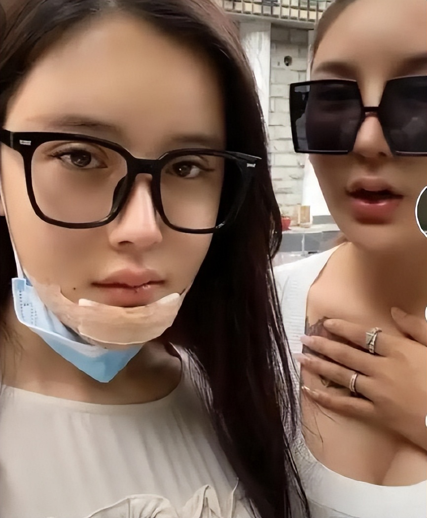 “桃花宝宝”迷恋整容，八年花费上百万，嘴歪眼斜额头出现大坑