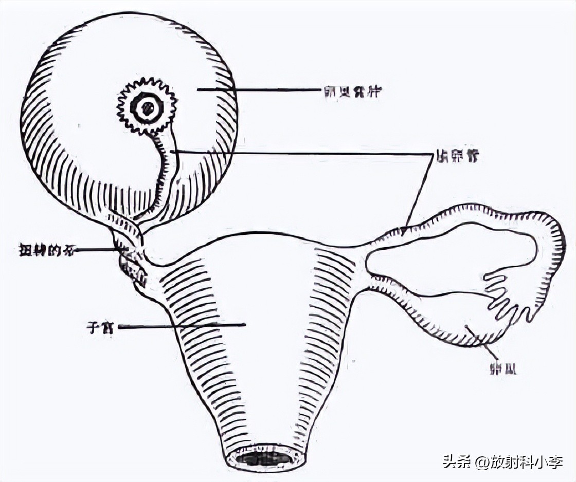 妇科急腹症的ct表现,妇科急腹症的诊断与治疗