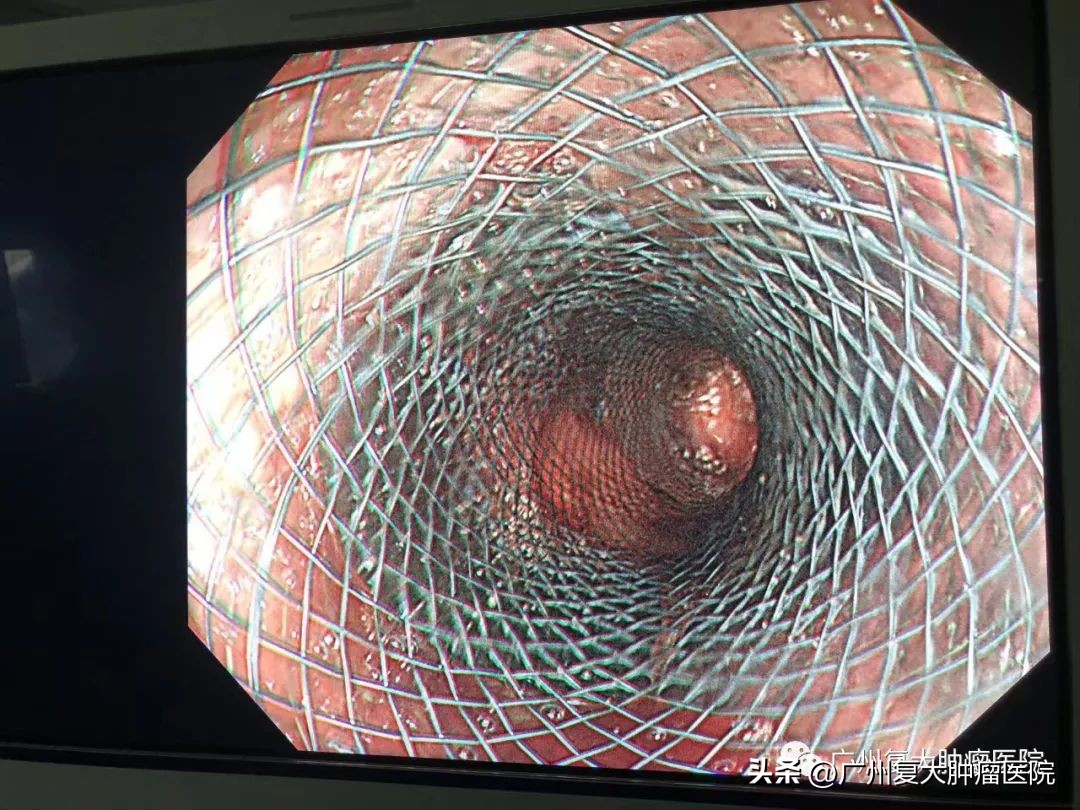 贲门癌晚期多器官转移,癌晚期多处转移