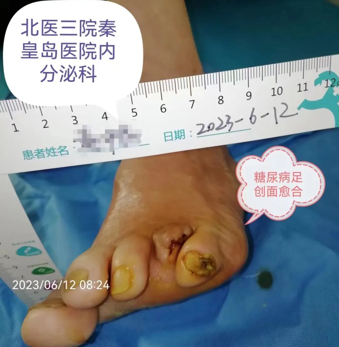 都是“鸡眼”惹的祸