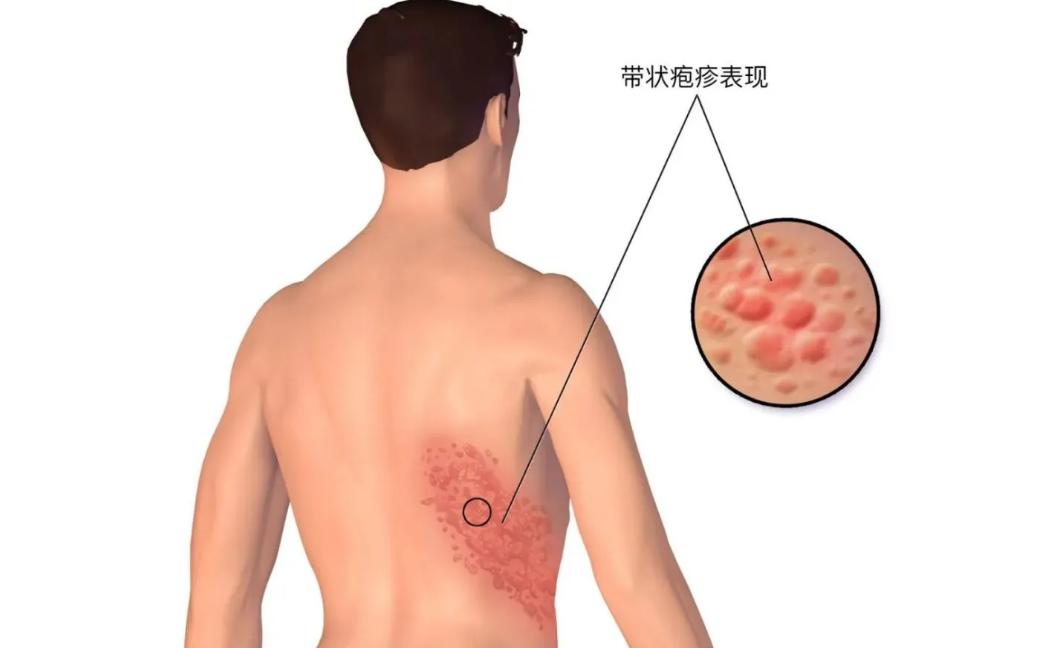 带状性疱疹的疼痛有何方法治疗,头上长带状疱疹怎么才能快速治愈
