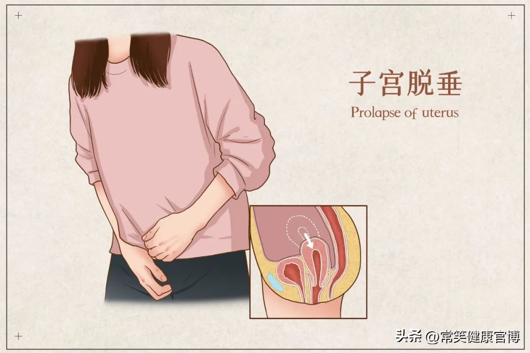 腰疼小便不利是肾炎,子宫脱垂会引起肚子疼腰疼吗