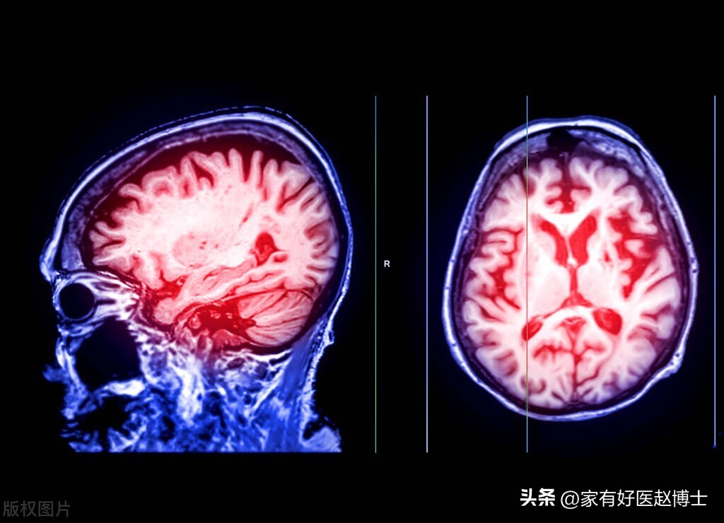 降压药吃了后头晕是什么原因,吃了降压药头有点晕怎么回事