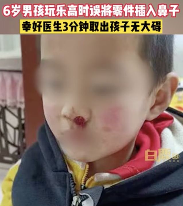 真狠！6岁熊孩子玩乐高时误将零件插入鼻中，导致鼻腔鲜血直流
