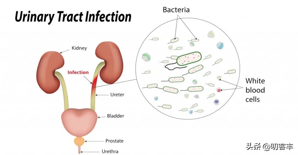 男孩子得了尿路感染有什么症状,男孩子尿路感染有什么表现