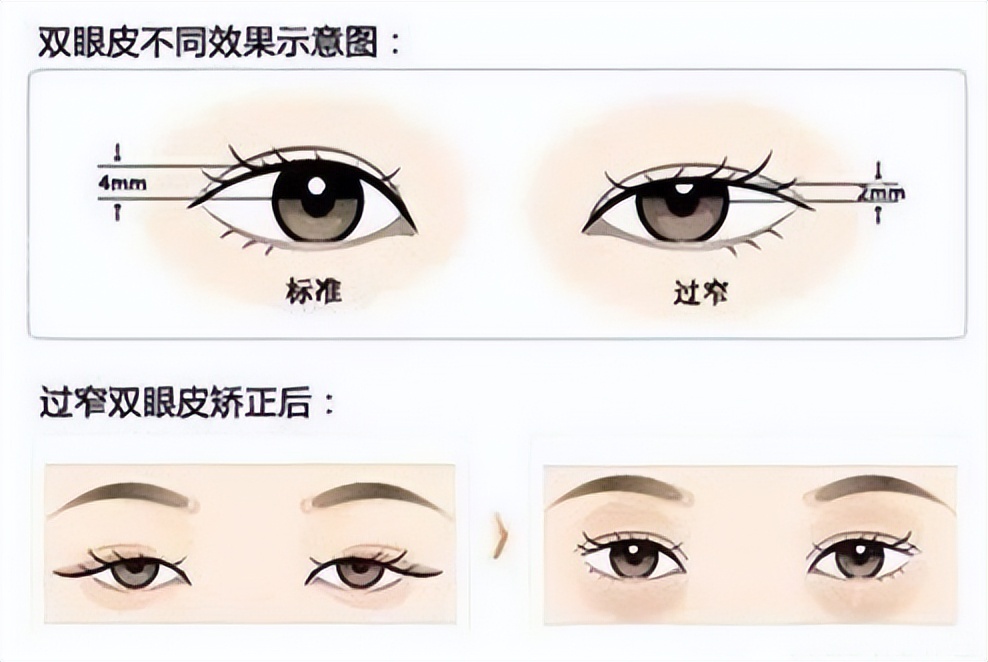 太原丽都双眼皮做的怎么样,太原市丽都整形医院做的好吗