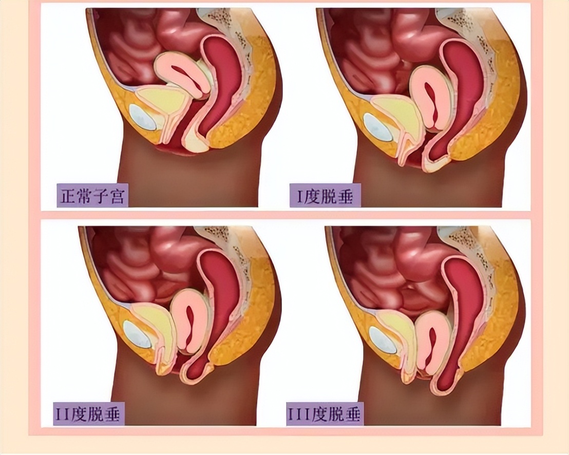 阴挺是什么症状表现,引起阴挺的病因有哪些