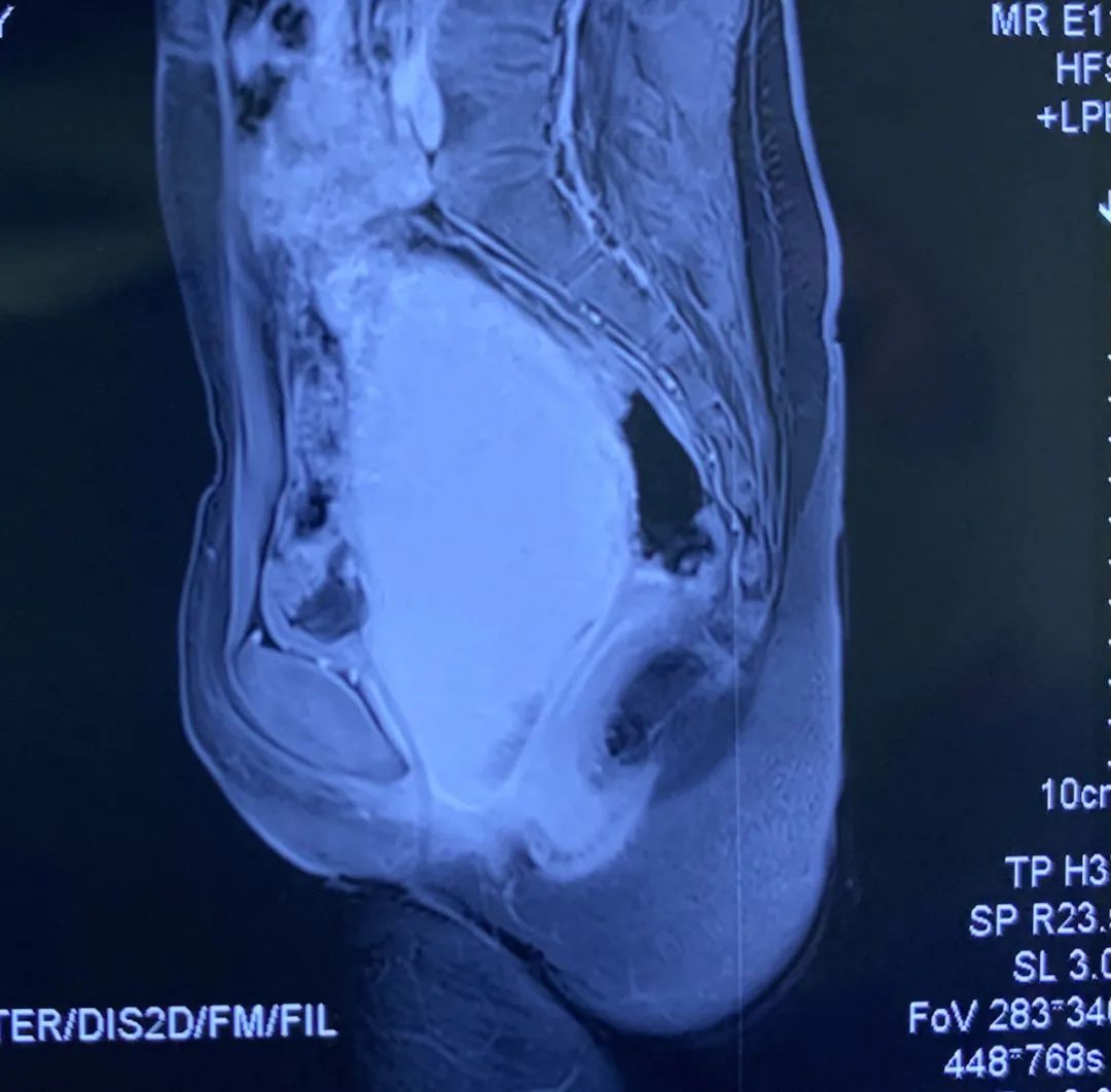 【300ML】上饶11岁少女腹痛排尿受阻，原来是处女膜闭锁惹的祸