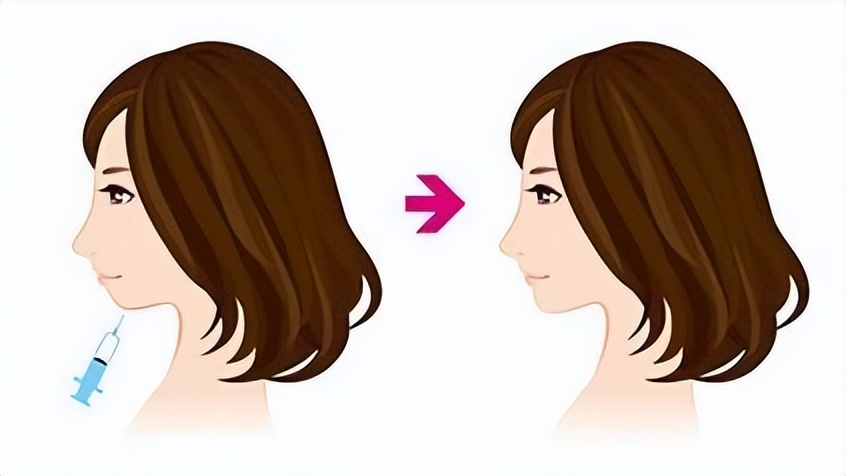 下巴后缩要怎么整形,下巴后缩做什么手术矫正
