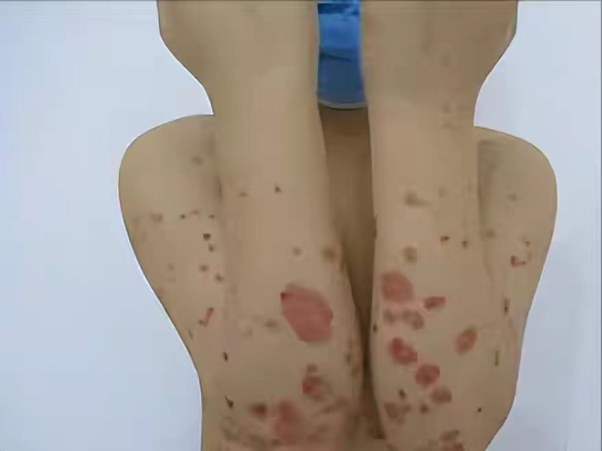 身上有牛皮癣为啥还一直出小红点,全身长满红疙瘩牛皮癣