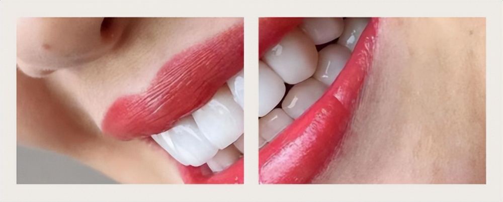 你需不需要做美牙，美伦美咖：这个问题该问谁？