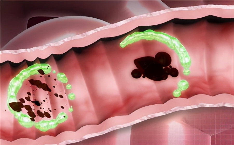 女性附件炎会不会引起小腹不适,女人左侧小腹疼附件炎怎么治