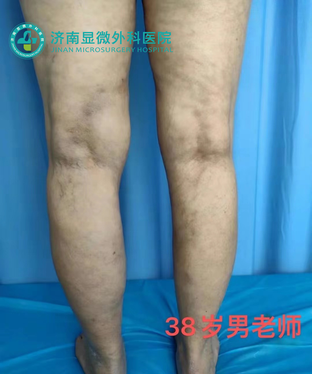 静脉曲张杨奎医生,静脉曲张患者去哪科治疗