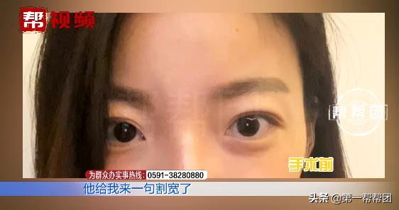 90后割双眼皮亲身经历,割了双眼皮后特后悔