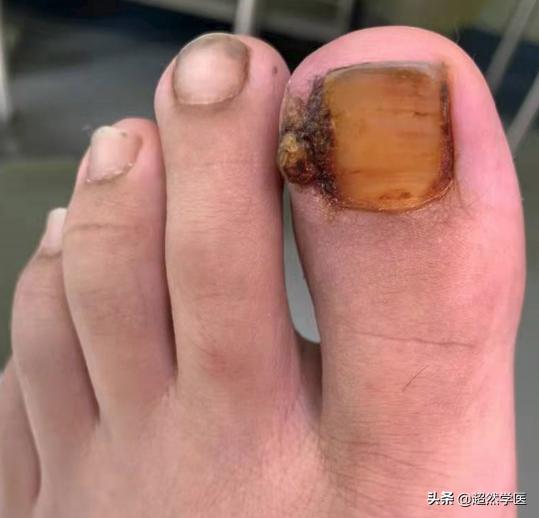 指甲受伤导致嵌甲,指甲增厚引起嵌甲修复
