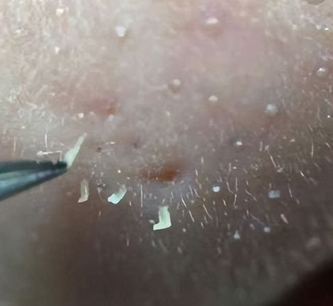 卸粉底后感觉鼻子上的毛孔有白点,为什么上完粉底液鼻子上有黑点