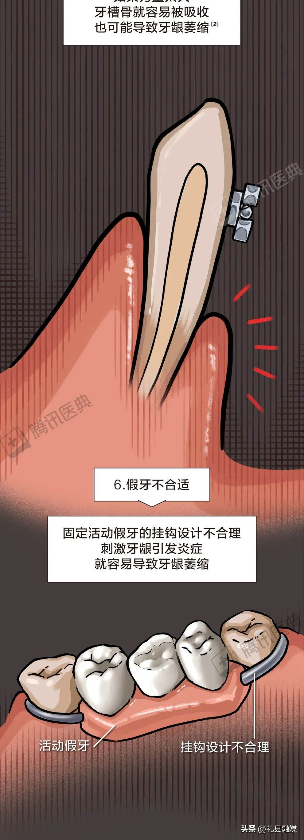 牙齿吃肉总是塞牙怎么治疗,吃肉吃菜老是塞牙怎么办