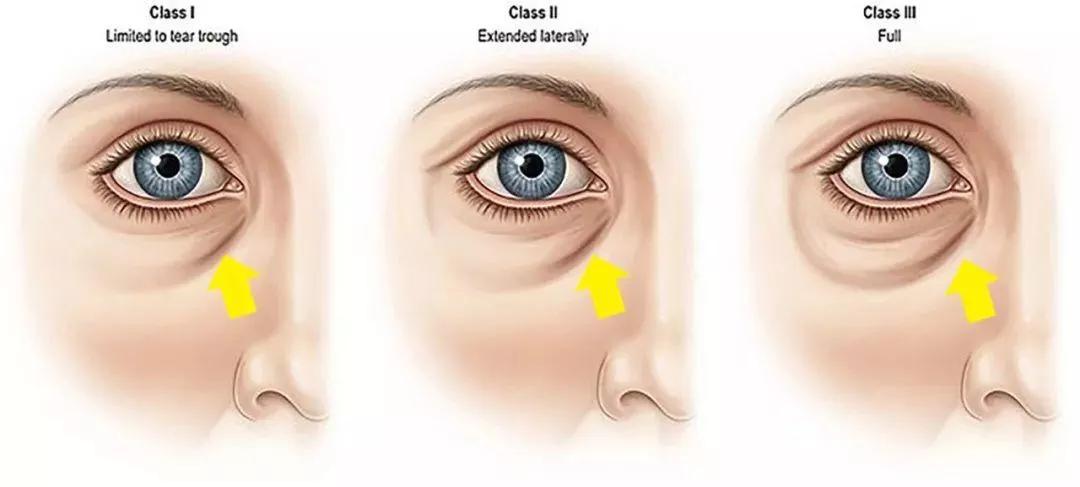 只需知道一招轻松消除显老泪沟,用什么办法能让泪沟修复