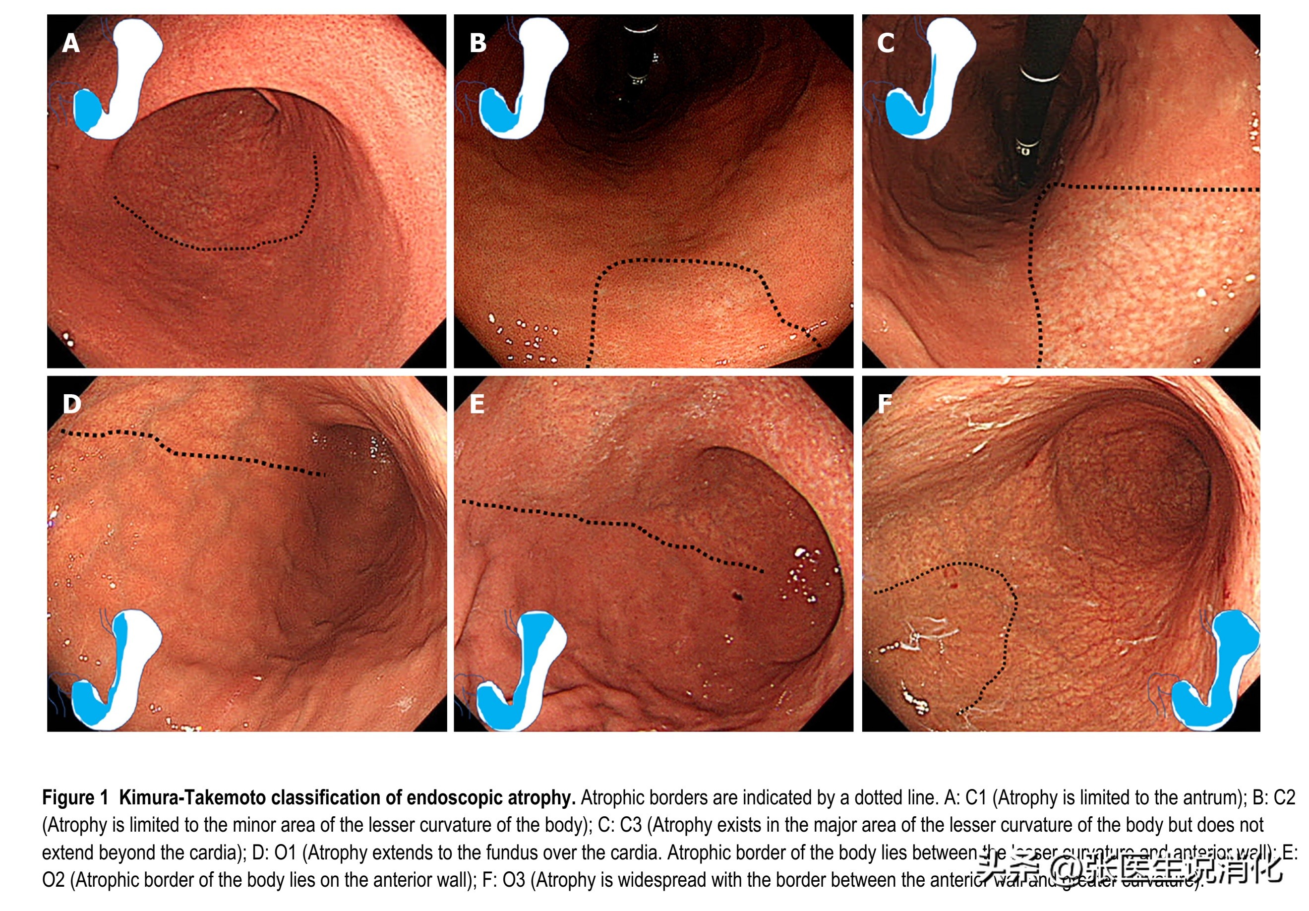 萎缩性胃炎c1是什么原因造成的,慢性萎缩性胃炎c1和c2哪个严重