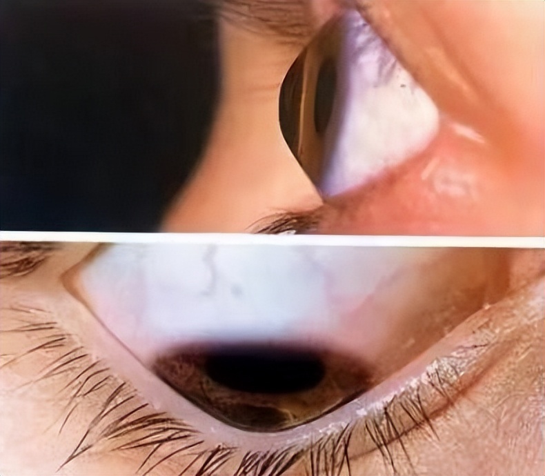 青光眼的发病跟情绪心理有关系吗,青光眼患者焦虑的原因