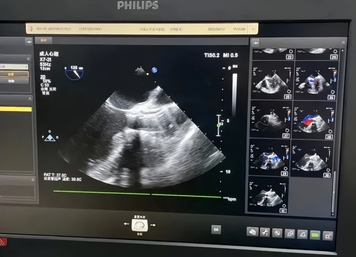 河南大学淮河医院顺利为一例二叶式主动脉瓣重度狭窄伴重度钙化的病人实施了经导管主动脉瓣置换术