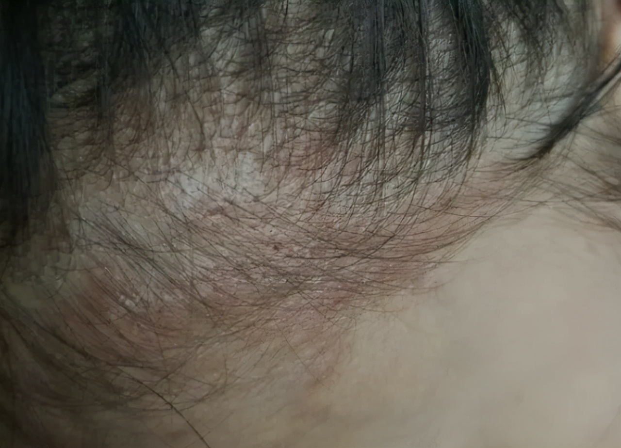 头上起疙瘩有脓包一挤出血,头上长疙瘩有脓包红肿怎么办