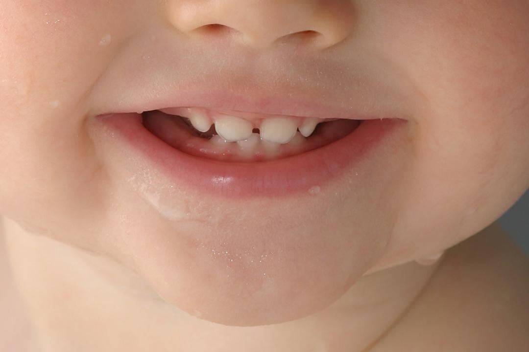 换牙期乳牙坏了要修补吗,乳牙坏了不就直接拔吗还补啥