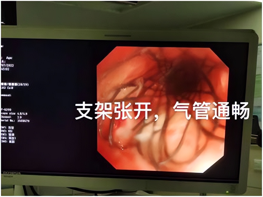 介入粒子植入和肿瘤消融术,微创可视细胞支架植入术