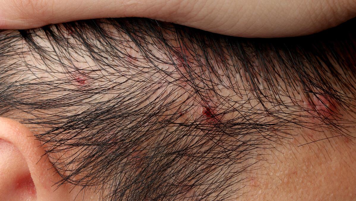 头皮出油长毛囊炎怎么办,夏天头皮毛囊炎