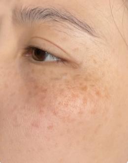 褐青色斑中医怎么治疗,中药调理能淡黄褐斑吗