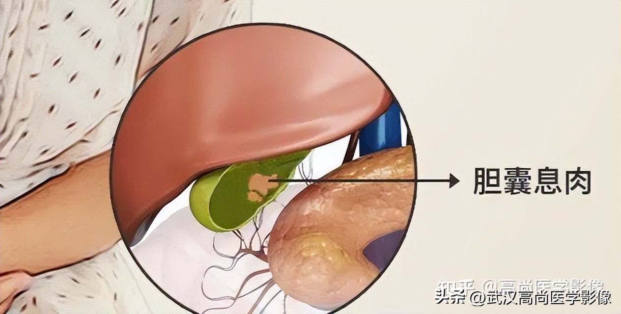 23岁体检有胆囊息肉怎么办,体检胆囊息肉有没有可能是误诊