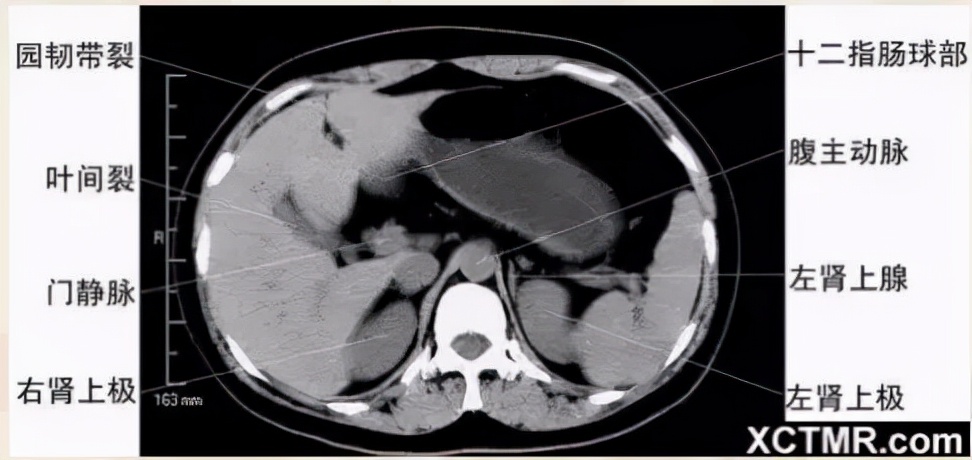 胸腹部盆腔ct主要检查什么,女性盆腔ct断层解剖结构图