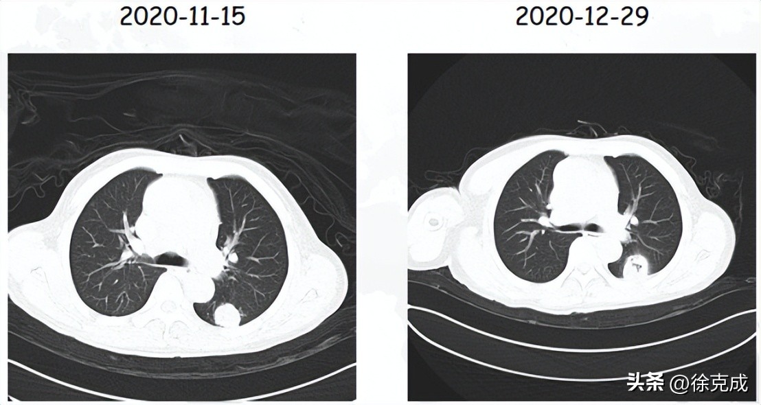 肺癌电场疗法,肺癌吸入疗法