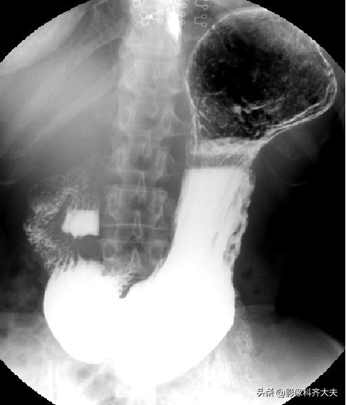 胃肠道造影超声解剖图,胃肠钡餐影像检查片子