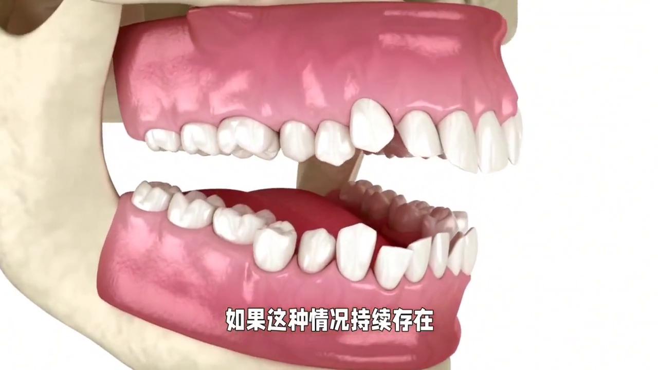 牙齿凸的原因,牙齿凸导致嘴凸怎么办