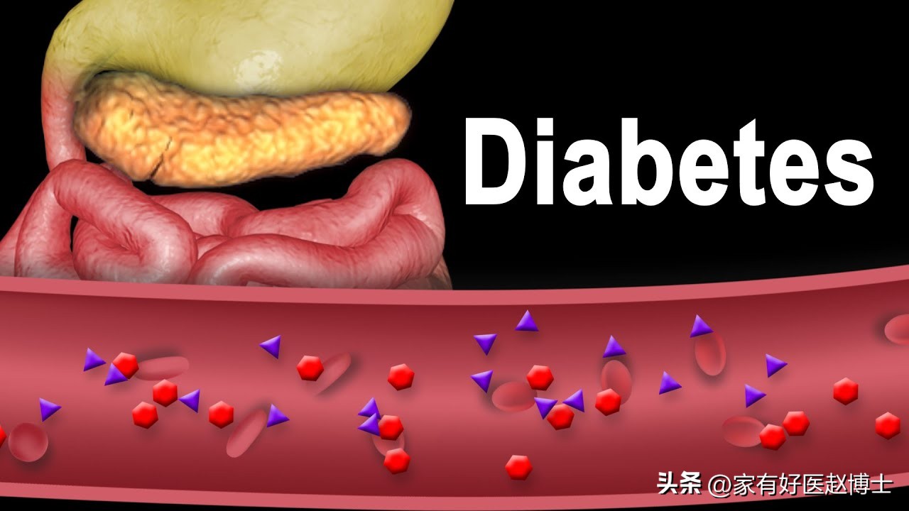 发现糖尿病怎么治疗,如果出现糖尿病前兆应该怎么控制