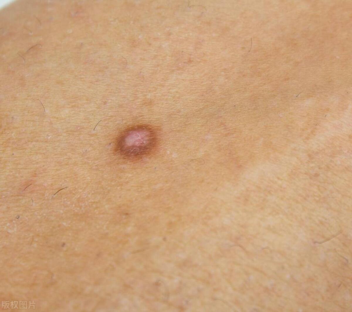 说说你身上留下疤痕的故事,每个人的伤疤都会有自己的故事