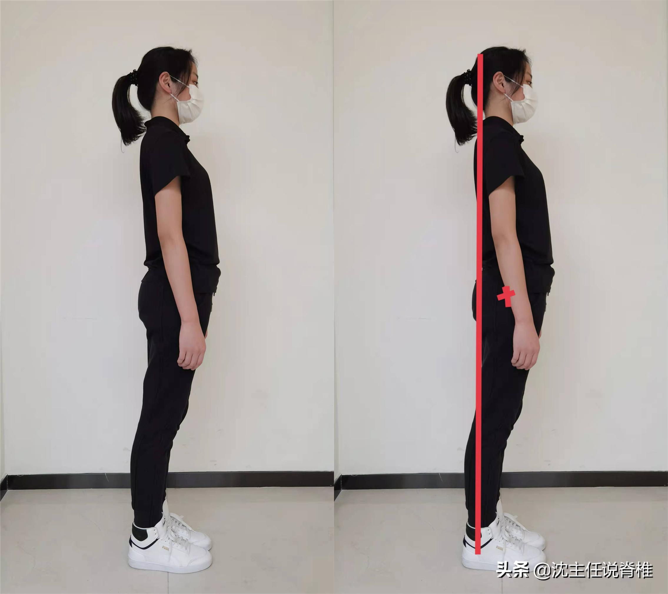 腰骶痛是不是腰突,腰骶疼是腰间盘突出吗