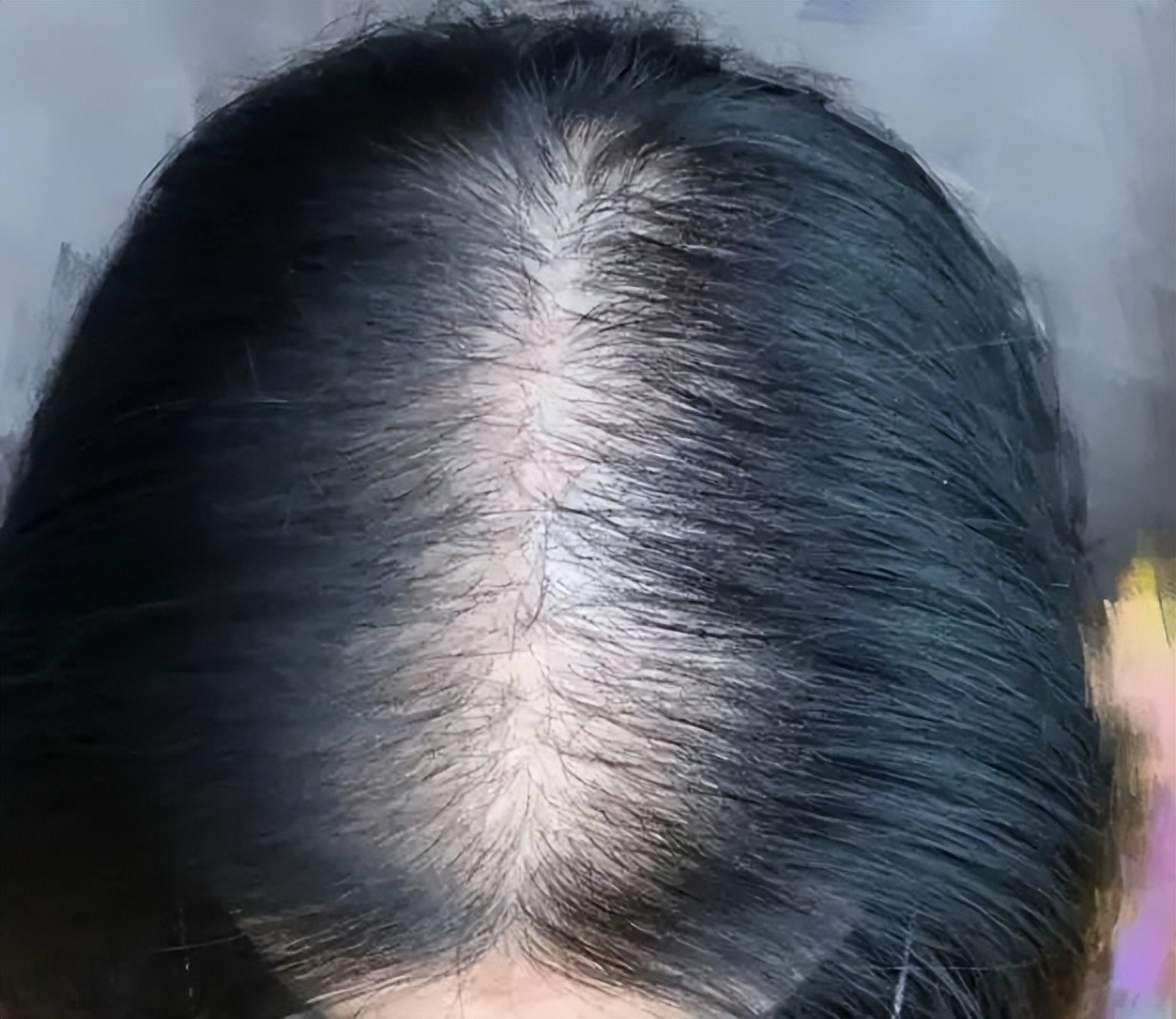 一女子坚持上海药皂洗头半年,一女子坚持硫磺皂洗头半年生发