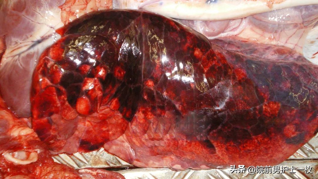 关于心绞痛护理措施的图片,冠心病心绞痛救治成功率