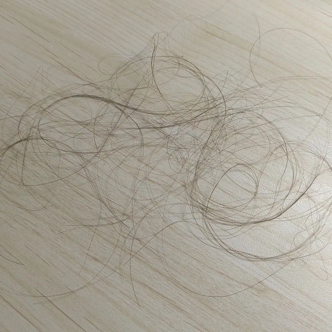 女大学生患「拔毛癖」八年，如魔鬼附身难忍抠头皮、拔头发